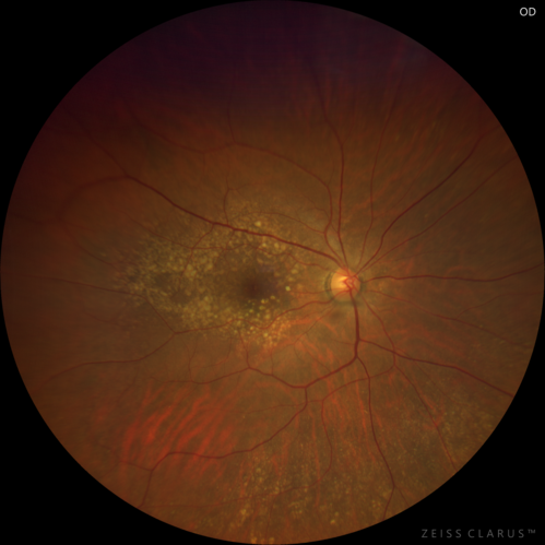 Intermediate Dry Age-Related Macular Degeneration - Soft Drusen
70-year-old Left eye worse than the right.  Both eyes see distortion in the amsler grid for a few months
HTN, High Lipids, Osteoporosis
Meds: Lutein once daily, Calcium, Fish oil, Red Yeast Rice, CoQ10, Magnesium, MVI, Xanax
VA 20/16 OU
2+NS cataract
