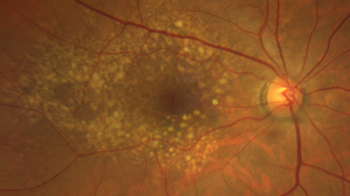 Intermediate Dry Age-Related Macular Degeneration - Soft Drusen
70-year-old Left eye worse than the right.  Both eyes see distortion in the amsler grid for a few months
HTN, High Lipids, Osteoporosis
Meds: Lutein once daily, Calcium, Fish oil, Red Yeast Rice, CoQ10, Magnesium, MVI, Xanax
VA 20/16 OU
2+NS cataract

