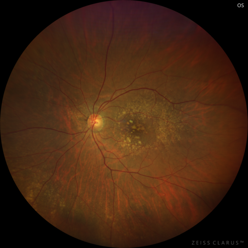 Intermediate Dry Age-Related Macular Degeneration - Soft Drusen
70-year-old Left eye worse than the right.  Both eyes see distortion in the amsler grid for a few months
HTN, High Lipids, Osteoporosis
Meds: Lutein once daily, Calcium, Fish oil, Red Yeast Rice, CoQ10, Magnesium, MVI, Xanax
VA 20/16 OU
2+NS cataract
