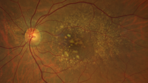 Intermediate Dry Age-Related Macular Degeneration - Soft Drusen
70-year-old Left eye worse than the right.  Both eyes see distortion in the amsler grid for a few months
HTN, High Lipids, Osteoporosis
Meds: Lutein once daily, Calcium, Fish oil, Red Yeast Rice, CoQ10, Magnesium, MVI, Xanax
VA 20/16 OU
2+NS cataract
