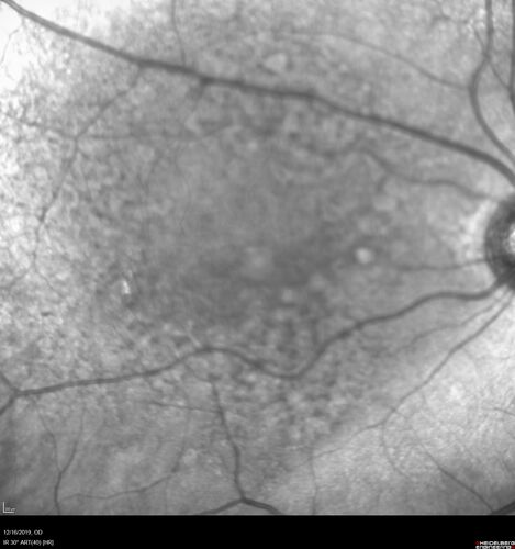 Intermediate Dry Age-Related Macular Degeneration - Soft Drusen
70-year-old Left eye worse than the right.  Both eyes see distortion in the amsler grid for a few months
HTN, High Lipids, Osteoporosis
Meds: Lutein once daily, Calcium, Fish oil, Red Yeast Rice, CoQ10, Magnesium, MVI, Xanax
VA 20/16 OU
2+NS cataract
