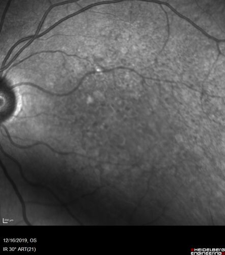 Intermediate Dry Age-Related Macular Degeneration - Soft Drusen
70-year-old Left eye worse than the right.  Both eyes see distortion in the amsler grid for a few months
HTN, High Lipids, Osteoporosis
Meds: Lutein once daily, Calcium, Fish oil, Red Yeast Rice, CoQ10, Magnesium, MVI, Xanax
VA 20/16 OU
2+NS cataract
