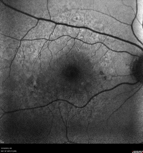 Intermediate Dry Age-Related Macular Degeneration - Soft Drusen
70-year-old Left eye worse than the right.  Both eyes see distortion in the amsler grid for a few months
HTN, High Lipids, Osteoporosis
Meds: Lutein once daily, Calcium, Fish oil, Red Yeast Rice, CoQ10, Magnesium, MVI, Xanax
VA 20/16 OU
2+NS cataract

