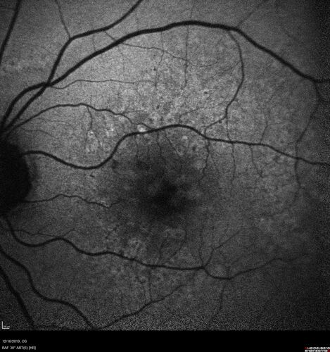 Intermediate Dry Age-Related Macular Degeneration - Soft Drusen
70-year-old Left eye worse than the right.  Both eyes see distortion in the amsler grid for a few months
HTN, High Lipids, Osteoporosis
Meds: Lutein once daily, Calcium, Fish oil, Red Yeast Rice, CoQ10, Magnesium, MVI, Xanax
VA 20/16 OU
2+NS cataract
