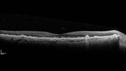 Intermediate Dry Age-Related Macular Degeneration - Soft Drusen
70-year-old Left eye worse than the right.  Both eyes see distortion in the amsler grid for a few months
HTN, High Lipids, Osteoporosis
Meds: Lutein once daily, Calcium, Fish oil, Red Yeast Rice, CoQ10, Magnesium, MVI, Xanax
VA 20/16 OU
2+NS cataract

