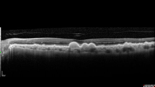 Intermediate Dry Age-Related Macular Degeneration - Soft Drusen
70-year-old Left eye worse than the right.  Both eyes see distortion in the amsler grid for a few months
HTN, High Lipids, Osteoporosis
Meds: Lutein once daily, Calcium, Fish oil, Red Yeast Rice, CoQ10, Magnesium, MVI, Xanax
VA 20/16 OU
2+NS cataract
