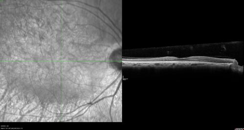 Sectoral Retinitis Pigmentosa - Asymptomatic
56-year-old female - The patient was in for an annual checkup because of her diabetes.Â  No visual complaints (no night vision trouble)
PMHx DM sine 2015, Asthma, Thyroid Disease, HTN
MEDS: Metformin, Levothyroxine, Lisinopril,, Inhaler
ROS Negative
VA OD: sc20/32-1 VA OS: sc20/32-1 
IOP: TP: OD:18 OS:17
293 Invitae genetic panel - negative
