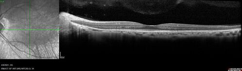 Sectoral Retinitis Pigmentosa - Asymptomatic
56-year-old female - The patient was in for an annual checkup because of her diabetes.Â  No visual complaints (no night vision trouble)
PMHx DM sine 2015, Asthma, Thyroid Disease, HTN
MEDS: Metformin, Levothyroxine, Lisinopril,, Inhaler
ROS Negative
VA OD: sc20/32-1 VA OS: sc20/32-1 
IOP: TP: OD:18 OS:17
293 Invitae genetic panel - negative

