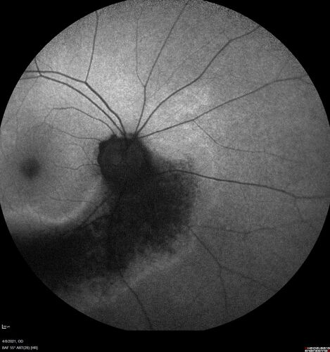 Sectoral Retinitis Pigmentosa - Asymptomatic
56-year-old female - The patient was in for an annual checkup because of her diabetes.Â  No visual complaints (no night vision trouble)
PMHx DM sine 2015, Asthma, Thyroid Disease, HTN
MEDS: Metformin, Levothyroxine, Lisinopril,, Inhaler
ROS Negative
VA OD: sc20/32-1 VA OS: sc20/32-1 
IOP: TP: OD:18 OS:17
293 Invitae genetic panel - negative

