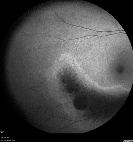 Sectoral Retinitis Pigmentosa - Asymptomatic
56-year-old female - The patient was in for an annual checkup because of her diabetes.Â  No visual complaints (no night vision trouble)
PMHx DM sine 2015, Asthma, Thyroid Disease, HTN
MEDS: Metformin, Levothyroxine, Lisinopril,, Inhaler
ROS Negative
VA OD: sc20/32-1 VA OS: sc20/32-1 
IOP: TP: OD:18 OS:17
293 Invitae genetic panel - negative
