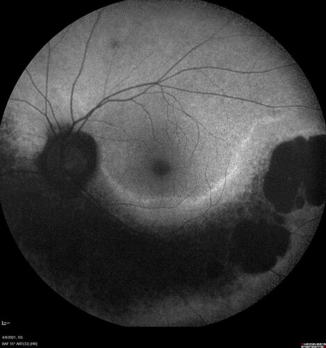 Sectoral Retinitis Pigmentosa - Asymptomatic
56-year-old female - The patient was in for an annual checkup because of her diabetes.Â  No visual complaints (no night vision trouble)
PMHx DM sine 2015, Asthma, Thyroid Disease, HTN
MEDS: Metformin, Levothyroxine, Lisinopril,, Inhaler
ROS Negative
VA OD: sc20/32-1 VA OS: sc20/32-1 
IOP: TP: OD:18 OS:17
293 Invitae genetic panel - negative
