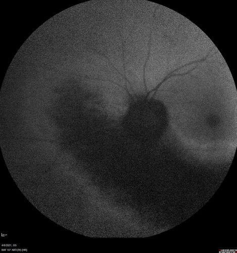 Sectoral Retinitis Pigmentosa - Asymptomatic
56-year-old female - The patient was in for an annual checkup because of her diabetes.Â  No visual complaints (no night vision trouble)
PMHx DM sine 2015, Asthma, Thyroid Disease, HTN
MEDS: Metformin, Levothyroxine, Lisinopril,, Inhaler
ROS Negative
VA OD: sc20/32-1 VA OS: sc20/32-1 
IOP: TP: OD:18 OS:17
293 Invitae genetic panel - negative
