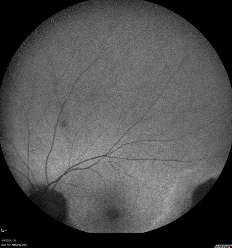 Sectoral Retinitis Pigmentosa - Asymptomatic
56-year-old female - The patient was in for an annual checkup because of her diabetes.Â  No visual complaints (no night vision trouble)
PMHx DM sine 2015, Asthma, Thyroid Disease, HTN
MEDS: Metformin, Levothyroxine, Lisinopril,, Inhaler
ROS Negative
VA OD: sc20/32-1 VA OS: sc20/32-1 
IOP: TP: OD:18 OS:17
293 Invitae genetic panel - negative
