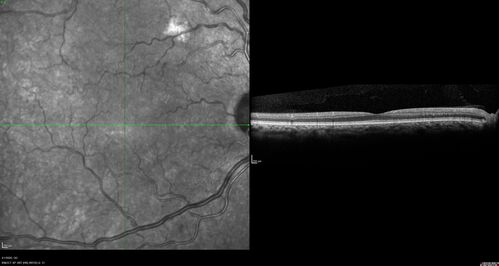Alcohol Amblyopia - Toxic Optic Neuropathy
59 year old man HPI: CC: Blurred Vision OU. Duration of Problem: about 7 months. Location: central vision. Context Onset/Aggravation: Started after using Accutane for 1 month. Associated Symptoms: no flashes or floaters. 
HX TECH: EA
VA OD: sc20/100 PH20/80+1 Nsc20/400 PAM20/50+2
VA OS: sc20/100 PH20/80-2 NscJ16 PAM20/50+1
IOP 24 OD, 26 OS
B-12 and Folate were normal - Presumed ETOH amblyopia  - improved to 20/63,20/80 after one year of B-12 supplements
IOP: TP: OD:24 OS:26 Time:02:08 PM
