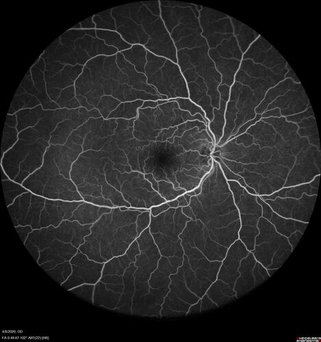 Alcohol Amblyopia - Toxic Optic Neuropathy
59 year old man HPI: CC: Blurred Vision OU. Duration of Problem: about 7 months. Location: central vision. Context Onset/Aggravation: Started after using Accutane for 1 month. Associated Symptoms: no flashes or floaters. 
HX TECH: EA
VA OD: sc20/100 PH20/80+1 Nsc20/400 PAM20/50+2
VA OS: sc20/100 PH20/80-2 NscJ16 PAM20/50+1
IOP 24 OD, 26 OS
B-12 and Folate were normal - Presumed ETOH amblyopia  - improved to 20/63,20/80 after one year of B-12 supplements
IOP: TP: OD:24 OS:26 Time:02:08 PM
