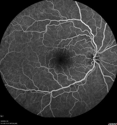 Alcohol Amblyopia - Toxic Optic Neuropathy
59 year old man HPI: CC: Blurred Vision OU. Duration of Problem: about 7 months. Location: central vision. Context Onset/Aggravation: Started after using Accutane for 1 month. Associated Symptoms: no flashes or floaters. 
HX TECH: EA
VA OD: sc20/100 PH20/80+1 Nsc20/400 PAM20/50+2
VA OS: sc20/100 PH20/80-2 NscJ16 PAM20/50+1
IOP 24 OD, 26 OS
B-12 and Folate were normal - Presumed ETOH amblyopia  - improved to 20/63,20/80 after one year of B-12 supplements
IOP: TP: OD:24 OS:26 Time:02:08 PM
