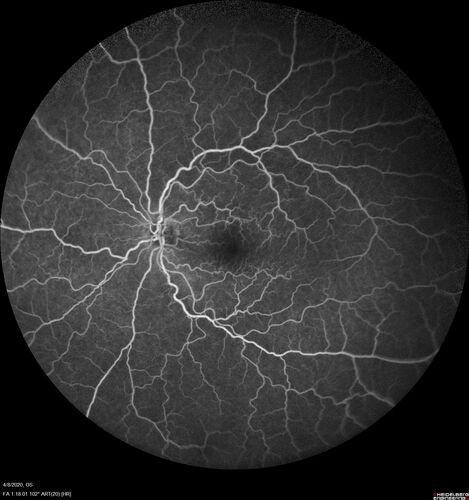 Alcohol Amblyopia - Toxic Optic Neuropathy
59 year old man HPI: CC: Blurred Vision OU. Duration of Problem: about 7 months. Location: central vision. Context Onset/Aggravation: Started after using Accutane for 1 month. Associated Symptoms: no flashes or floaters. 
HX TECH: EA
VA OD: sc20/100 PH20/80+1 Nsc20/400 PAM20/50+2
VA OS: sc20/100 PH20/80-2 NscJ16 PAM20/50+1
IOP 24 OD, 26 OS
B-12 and Folate were normal - Presumed ETOH amblyopia  - improved to 20/63,20/80 after one year of B-12 supplements
IOP: TP: OD:24 OS:26 Time:02:08 PM
