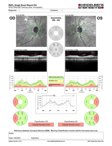 Alcohol Amblyopia - Toxic Optic Neuropathy
59 year old man HPI: CC: Blurred Vision OU. Duration of Problem: about 7 months. Location: central vision. Context Onset/Aggravation: Started after using Accutane for 1 month. Associated Symptoms: no flashes or floaters. 
HX TECH: EA
VA OD: sc20/100 PH20/80+1 Nsc20/400 PAM20/50+2
VA OS: sc20/100 PH20/80-2 NscJ16 PAM20/50+1
IOP 24 OD, 26 OS
B-12 and Folate were normal - Presumed ETOH amblyopia  - improved to 20/63,20/80 after one year of B-12 supplements
IOP: TP: OD:24 OS:26 Time:02:08 PM
