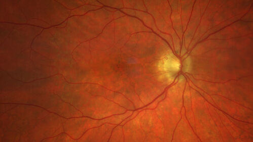 Elmiron (pentasosan polysulfate) Macular Toxicity
77 year old female who had been on Elmiron for 20 years  and stopped it 2 years ago
