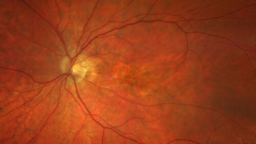 Elmiron (pentasosan polysulfate) Macular Toxicity
77 year old female who had been on Elmiron for 20 years  and stopped it 2 years ago

