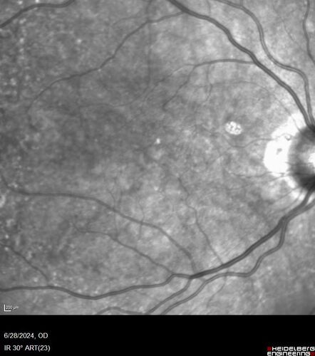Elmiron (pentasosan polysulfate) Macular Toxicity
77 year old female who had been on Elmiron for 20 years  and stopped it 2 years ago

