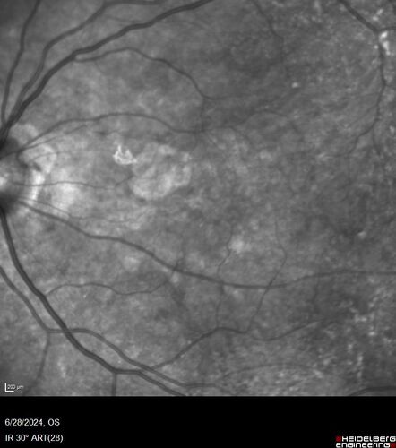 Elmiron (pentasosan polysulfate) Macular Toxicity
77 year old female who had been on Elmiron for 20 years  and stopped it 2 years ago
