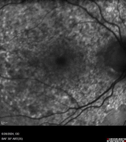 Elmiron (pentasosan polysulfate) Macular Toxicity
77 year old female who had been on Elmiron for 20 years  and stopped it 2 years ago
