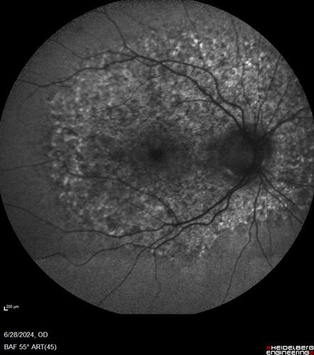 Elmiron (pentasosan polysulfate) Macular Toxicity
77 year old female who had been on Elmiron for 20 years  and stopped it 2 years ago
