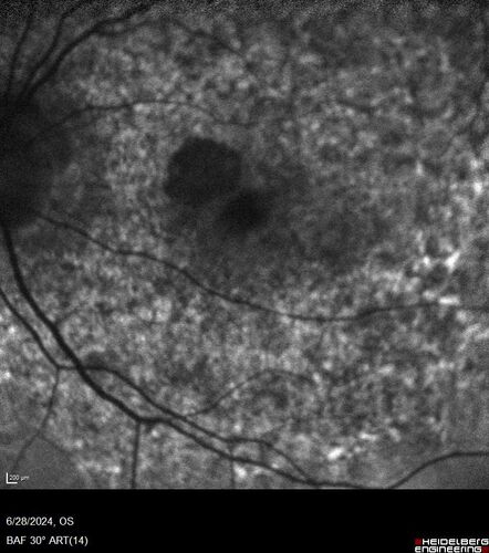 Elmiron (pentasosan polysulfate) Macular Toxicity
77 year old female who had been on Elmiron for 20 years  and stopped it 2 years ago
