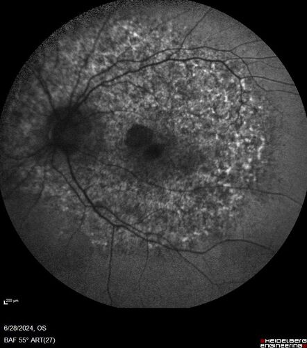 Elmiron (pentasosan polysulfate) Macular Toxicity
77 year old female who had been on Elmiron for 20 years  and stopped it 2 years ago
