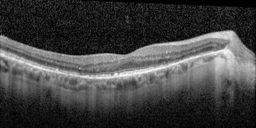 Elmiron (pentasosan polysulfate) Macular Toxicity
77 year old female who had been on Elmiron for 20 years  and stopped it 2 years ago
