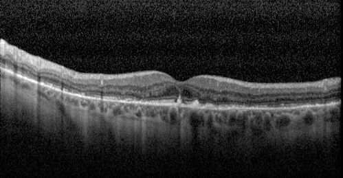 Elmiron (pentasosan polysulfate) Macular Toxicity
77 year old female who had been on Elmiron for 20 years  and stopped it 2 years ago
