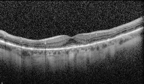 Elmiron (pentasosan polysulfate) Macular Toxicity
77 year old female who had been on Elmiron for 20 years  and stopped it 2 years ago
