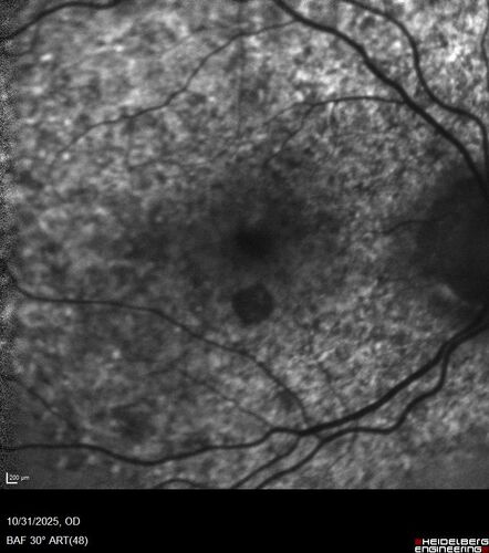 Elmiron (pentasosan polysulfate) Macular Toxicity
77 year old female who had been on Elmiron for 20 years  and stopped it 2 years ago
