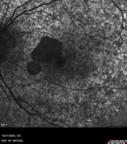 Elmiron (pentasosan polysulfate) Macular Toxicity
77 year old female who had been on Elmiron for 20 years  and stopped it 2 years ago

