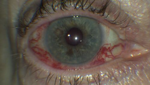 Elevated Episcleral Venous Pressure and Retinal Hemorrhages in both eyes
78 year old female with chronic red eye.   The eyes are red all the time now.  She is on Xeralto because of a history of blood clots in her lungs (2005 about).  She has not had problems since.  She has had floaters for many years.  Ever since her eyes got funny she sees more floaters in both eyes.  She had a brain scan over 6 months ago which was OK.  She also had double vision when this first started which went away.  She could not drive for a few months.  
VA OD: Dcc20/32-1 
VA OS: Dcc20/125 
IOP: TP: OD:17 OS:16
Neuroimaging did not show a CC fistula

