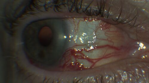 Elevated Episcleral Venous Pressure and Retinal Hemorrhages in both eyes
78 year old female with chronic red eye.   The eyes are red all the time now.  She is on Xeralto because of a history of blood clots in her lungs (2005 about).  She has not had problems since.  She has had floaters for many years.  Ever since her eyes got funny she sees more floaters in both eyes.  She had a brain scan over 6 months ago which was OK.  She also had double vision when this first started which went away.  She could not drive for a few months.  
VA OD: Dcc20/32-1 
VA OS: Dcc20/125 
IOP: TP: OD:17 OS:16
Neuroimaging did not show a CC fistula
