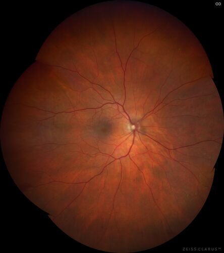Elevated Episcleral Venous Pressure and Retinal Hemorrhages in both eyes
78 year old female with chronic red eye.   The eyes are red all the time now.  She is on Xeralto because of a history of blood clots in her lungs (2005 about).  She has not had problems since.  She has had floaters for many years.  Ever since her eyes got funny she sees more floaters in both eyes.  She had a brain scan over 6 months ago which was OK.  She also had double vision when this first started which went away.  She could not drive for a few months.  
VA OD: Dcc20/32-1 
VA OS: Dcc20/125 
IOP: TP: OD:17 OS:16
Neuroimaging did not show a CC fistula

