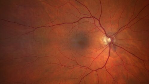 Elevated Episcleral Venous Pressure and Retinal Hemorrhages in both eyes
78 year old female with chronic red eye.   The eyes are red all the time now.  She is on Xeralto because of a history of blood clots in her lungs (2005 about).  She has not had problems since.  She has had floaters for many years.  Ever since her eyes got funny she sees more floaters in both eyes.  She had a brain scan over 6 months ago which was OK.  She also had double vision when this first started which went away.  She could not drive for a few months.  
VA OD: Dcc20/32-1 
VA OS: Dcc20/125 
IOP: TP: OD:17 OS:16
Neuroimaging did not show a CC fistula
