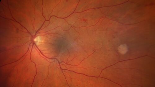 Elevated Episcleral Venous Pressure and Retinal Hemorrhages in both eyes
78 year old female with chronic red eye.   The eyes are red all the time now.  She is on Xeralto because of a history of blood clots in her lungs (2005 about).  She has not had problems since.  She has had floaters for many years.  Ever since her eyes got funny she sees more floaters in both eyes.  She had a brain scan over 6 months ago which was OK.  She also had double vision when this first started which went away.  She could not drive for a few months.  
VA OD: Dcc20/32-1 
VA OS: Dcc20/125 
IOP: TP: OD:17 OS:16
Neuroimaging did not show a CC fistula
