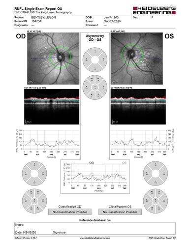 Elevated Episcleral Venous Pressure and Retinal Hemorrhages in both eyes
78 year old female with chronic red eye.   The eyes are red all the time now.  She is on Xeralto because of a history of blood clots in her lungs (2005 about).  She has not had problems since.  She has had floaters for many years.  Ever since her eyes got funny she sees more floaters in both eyes.  She had a brain scan over 6 months ago which was OK.  She also had double vision when this first started which went away.  She could not drive for a few months.  
VA OD: Dcc20/32-1 
VA OS: Dcc20/125 
IOP: TP: OD:17 OS:16
Neuroimaging did not show a CC fistula
