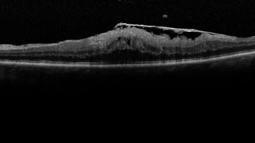 Elevated Episcleral Venous Pressure and Retinal Hemorrhages in both eyes
78 year old female with chronic red eye.   The eyes are red all the time now.  She is on Xeralto because of a history of blood clots in her lungs (2005 about).  She has not had problems since.  She has had floaters for many years.  Ever since her eyes got funny she sees more floaters in both eyes.  She had a brain scan over 6 months ago which was OK.  She also had double vision when this first started which went away.  She could not drive for a few months.  
VA OD: Dcc20/32-1 
VA OS: Dcc20/125 
IOP: TP: OD:17 OS:16
Neuroimaging did not show a CC fistula
