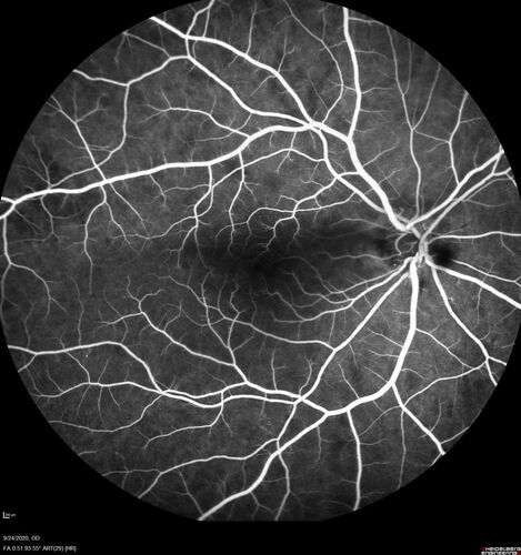 Elevated Episcleral Venous Pressure and Retinal Hemorrhages in both eyes
78 year old female with chronic red eye.   The eyes are red all the time now.  She is on Xeralto because of a history of blood clots in her lungs (2005 about).  She has not had problems since.  She has had floaters for many years.  Ever since her eyes got funny she sees more floaters in both eyes.  She had a brain scan over 6 months ago which was OK.  She also had double vision when this first started which went away.  She could not drive for a few months.  
VA OD: Dcc20/32-1 
VA OS: Dcc20/125 
IOP: TP: OD:17 OS:16
Neuroimaging did not show a CC fistula
