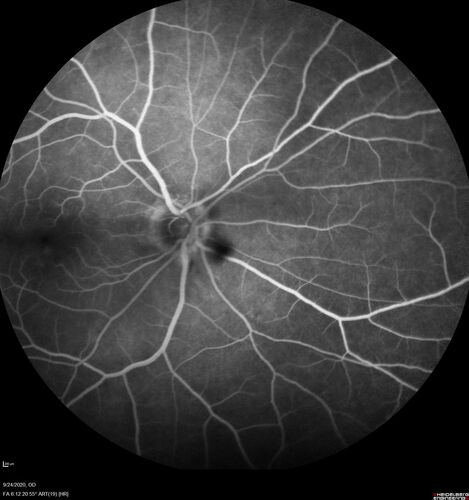 Elevated Episcleral Venous Pressure and Retinal Hemorrhages in both eyes
78 year old female with chronic red eye.   The eyes are red all the time now.  She is on Xeralto because of a history of blood clots in her lungs (2005 about).  She has not had problems since.  She has had floaters for many years.  Ever since her eyes got funny she sees more floaters in both eyes.  She had a brain scan over 6 months ago which was OK.  She also had double vision when this first started which went away.  She could not drive for a few months.  
VA OD: Dcc20/32-1 
VA OS: Dcc20/125 
IOP: TP: OD:17 OS:16
Neuroimaging did not show a CC fistula
