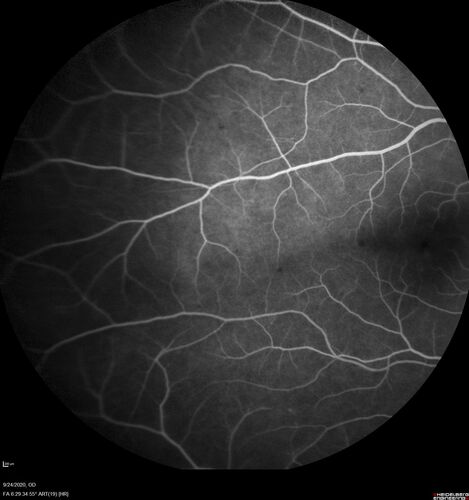 Elevated Episcleral Venous Pressure and Retinal Hemorrhages in both eyes
78 year old female with chronic red eye.   The eyes are red all the time now.  She is on Xeralto because of a history of blood clots in her lungs (2005 about).  She has not had problems since.  She has had floaters for many years.  Ever since her eyes got funny she sees more floaters in both eyes.  She had a brain scan over 6 months ago which was OK.  She also had double vision when this first started which went away.  She could not drive for a few months.  
VA OD: Dcc20/32-1 
VA OS: Dcc20/125 
IOP: TP: OD:17 OS:16
Neuroimaging did not show a CC fistula

