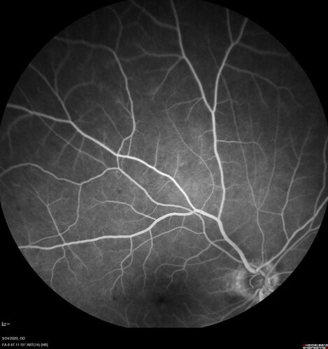 Elevated Episcleral Venous Pressure and Retinal Hemorrhages in both eyes
78 year old female with chronic red eye.   The eyes are red all the time now.  She is on Xeralto because of a history of blood clots in her lungs (2005 about).  She has not had problems since.  She has had floaters for many years.  Ever since her eyes got funny she sees more floaters in both eyes.  She had a brain scan over 6 months ago which was OK.  She also had double vision when this first started which went away.  She could not drive for a few months.  
VA OD: Dcc20/32-1 
VA OS: Dcc20/125 
IOP: TP: OD:17 OS:16
Neuroimaging did not show a CC fistula
