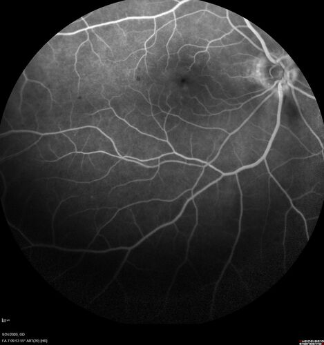 Elevated Episcleral Venous Pressure and Retinal Hemorrhages in both eyes
78 year old female with chronic red eye.   The eyes are red all the time now.  She is on Xeralto because of a history of blood clots in her lungs (2005 about).  She has not had problems since.  She has had floaters for many years.  Ever since her eyes got funny she sees more floaters in both eyes.  She had a brain scan over 6 months ago which was OK.  She also had double vision when this first started which went away.  She could not drive for a few months.  
VA OD: Dcc20/32-1 
VA OS: Dcc20/125 
IOP: TP: OD:17 OS:16
Neuroimaging did not show a CC fistula
