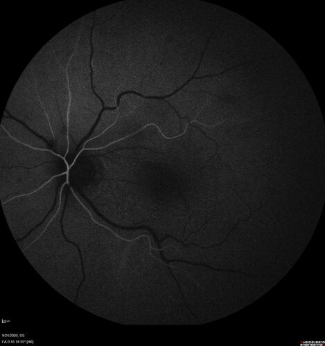 Elevated Episcleral Venous Pressure and Retinal Hemorrhages in both eyes
78 year old female with chronic red eye.   The eyes are red all the time now.  She is on Xeralto because of a history of blood clots in her lungs (2005 about).  She has not had problems since.  She has had floaters for many years.  Ever since her eyes got funny she sees more floaters in both eyes.  She had a brain scan over 6 months ago which was OK.  She also had double vision when this first started which went away.  She could not drive for a few months.  
VA OD: Dcc20/32-1 
VA OS: Dcc20/125 
IOP: TP: OD:17 OS:16
Neuroimaging did not show a CC fistula
