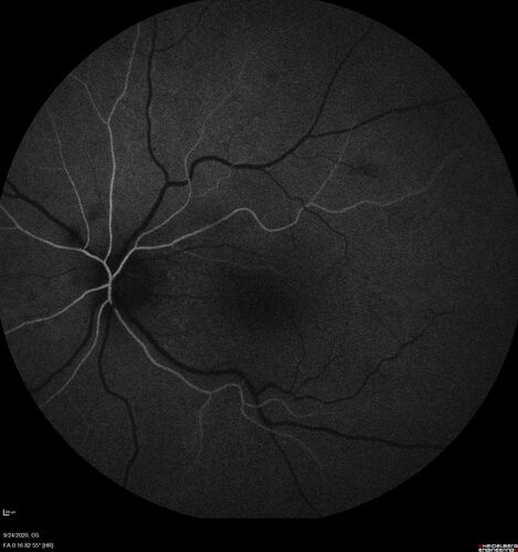 Elevated Episcleral Venous Pressure and Retinal Hemorrhages in both eyes
78 year old female with chronic red eye.   The eyes are red all the time now.  She is on Xeralto because of a history of blood clots in her lungs (2005 about).  She has not had problems since.  She has had floaters for many years.  Ever since her eyes got funny she sees more floaters in both eyes.  She had a brain scan over 6 months ago which was OK.  She also had double vision when this first started which went away.  She could not drive for a few months.  
VA OD: Dcc20/32-1 
VA OS: Dcc20/125 
IOP: TP: OD:17 OS:16
Neuroimaging did not show a CC fistula
