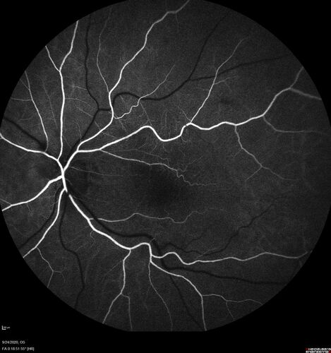 Elevated Episcleral Venous Pressure and Retinal Hemorrhages in both eyes
78 year old female with chronic red eye.   The eyes are red all the time now.  She is on Xeralto because of a history of blood clots in her lungs (2005 about).  She has not had problems since.  She has had floaters for many years.  Ever since her eyes got funny she sees more floaters in both eyes.  She had a brain scan over 6 months ago which was OK.  She also had double vision when this first started which went away.  She could not drive for a few months.  
VA OD: Dcc20/32-1 
VA OS: Dcc20/125 
IOP: TP: OD:17 OS:16
Neuroimaging did not show a CC fistula
